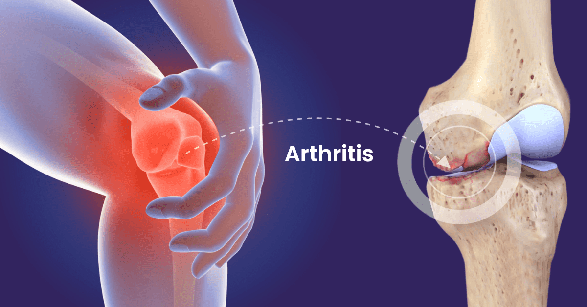 Arthritis Pain Relief: Effective Remedies to try