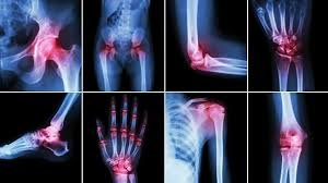 Arthritis Pain Relief