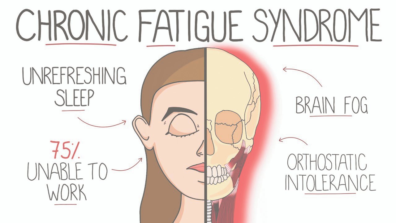 Chronic Fatigue Syndrome: Understanding the Symptoms