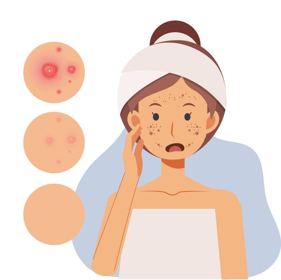 How to Get Rid of Acne at home? What are the Treatments?